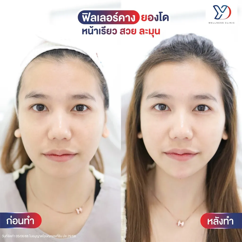 ฟิลเลอร์คาง ก่อน-หลัง มุมด้านหน้า