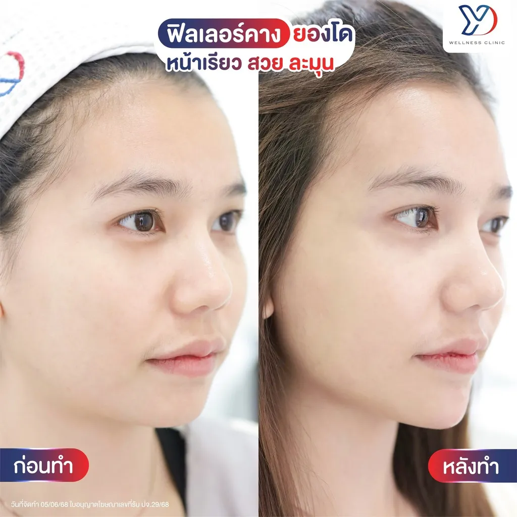 ฟิลเลอร์คาง ก่อน-หลัง มุมด้านข้าง