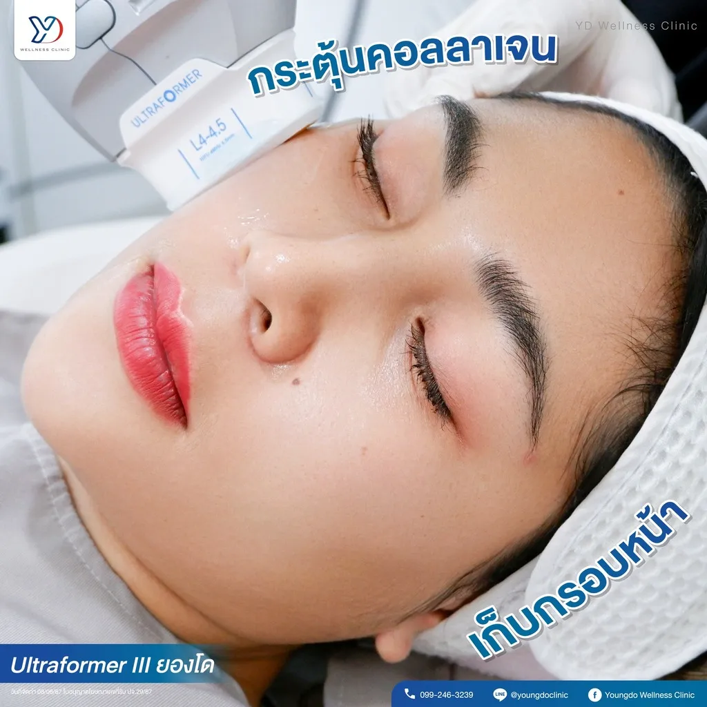การกระตุ้นคอลลาเจนและเก็บกรอบหน้า