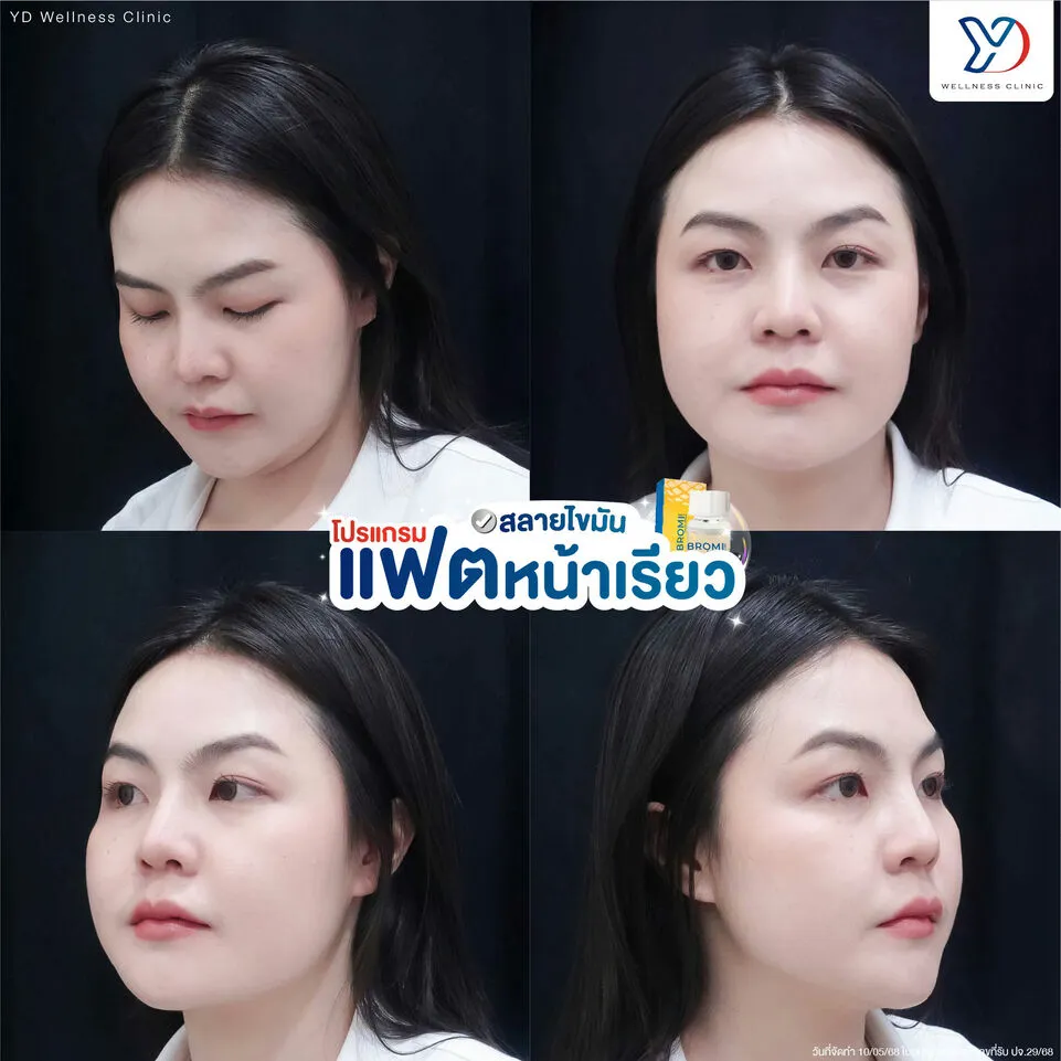 การสลายไขมันหน้า ก่อน-หลัง