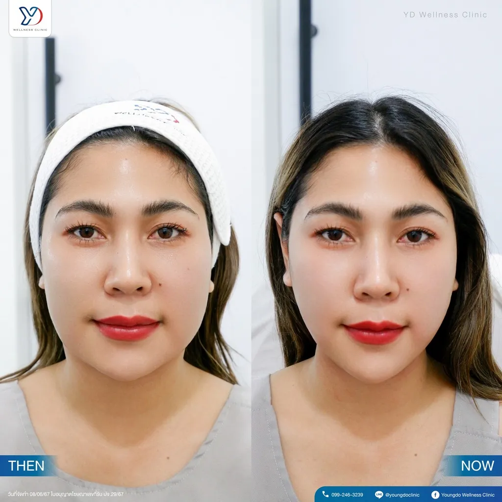 การยกกระชับใบหน้า ก่อน-หลัง