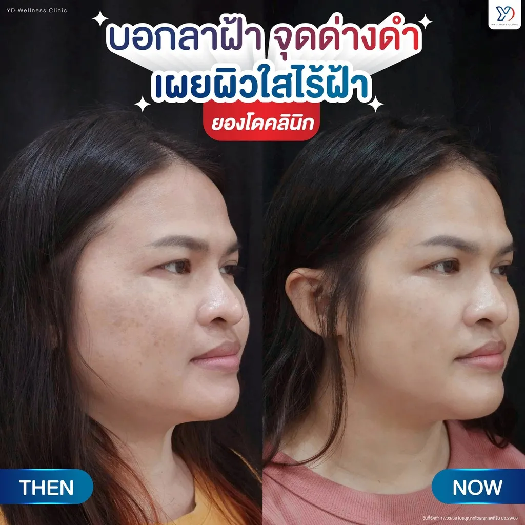 ฝ้าและจุดด่างดำ ก่อน-หลัง ด้านข้าง