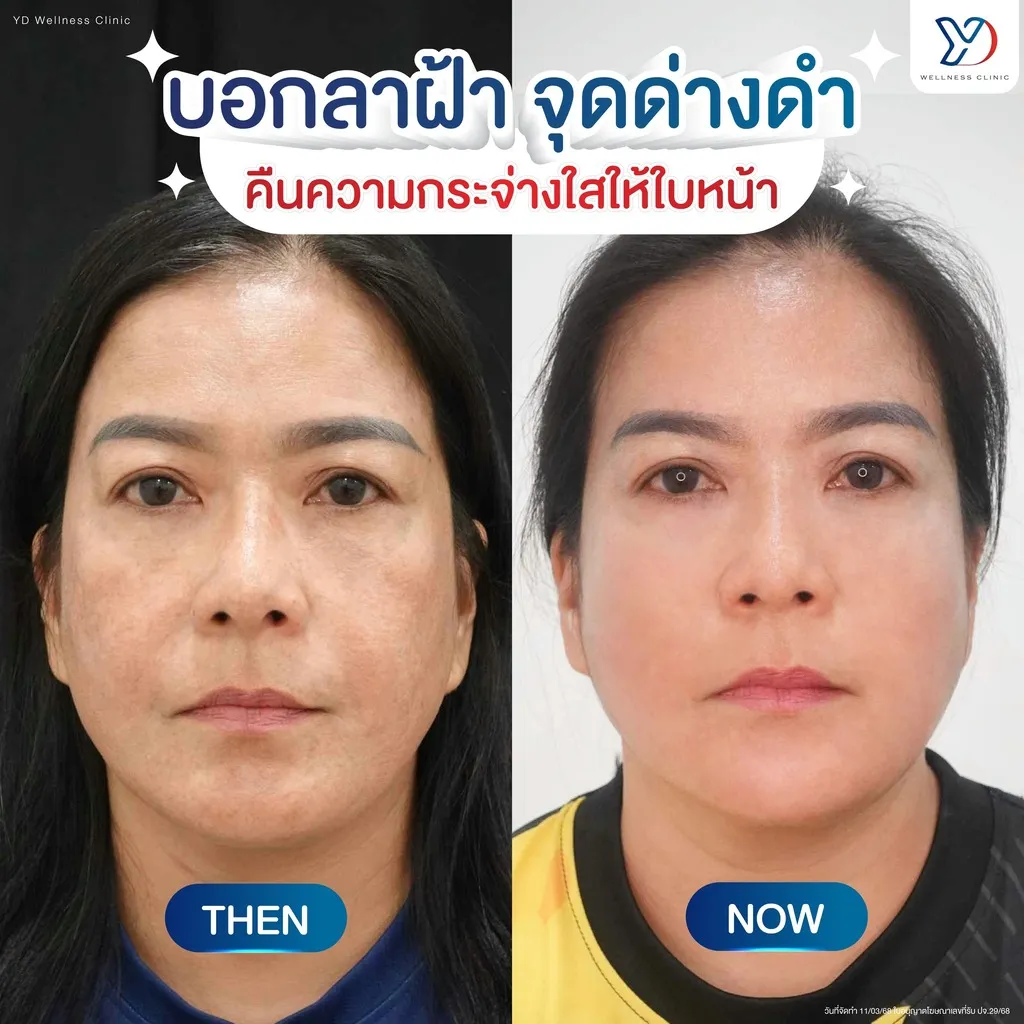 ฝ้าและจุดด่างดำ ก่อน-หลัง