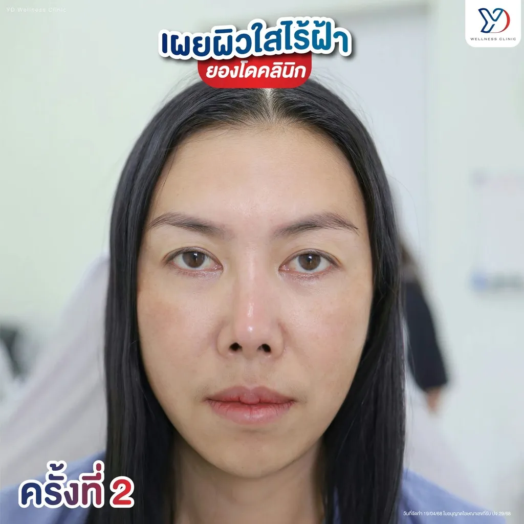 การรักษาฝ้าครั้งที่ 2