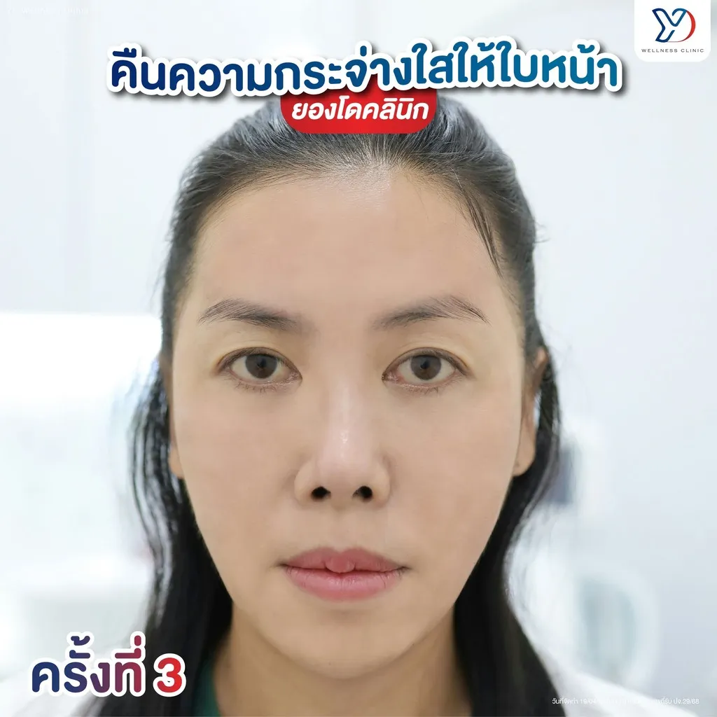 การรักษาฝ้าครั้งที่ 3