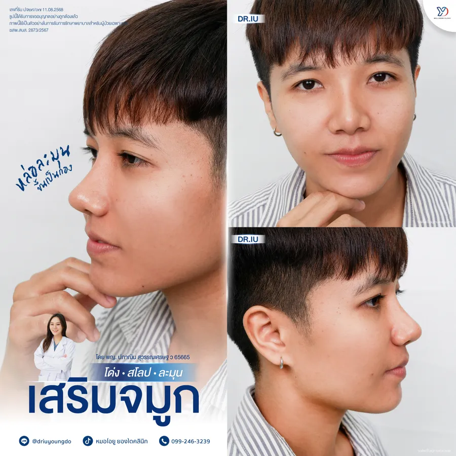การเสริมจมูกผู้ชายโดยหมอไอยู
