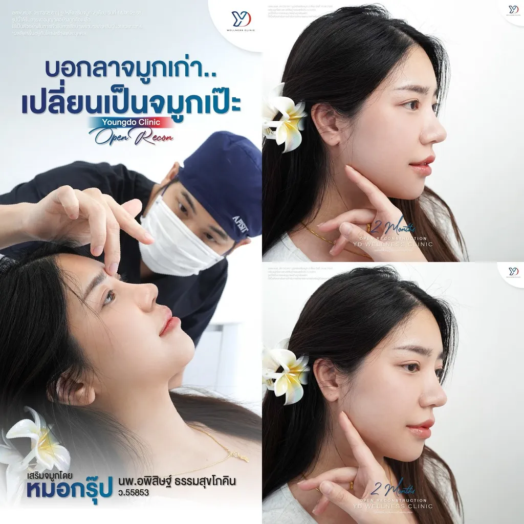 บอกลาจมูกเก่า เปลี่ยนเป็นจมูกเป๊ะ
