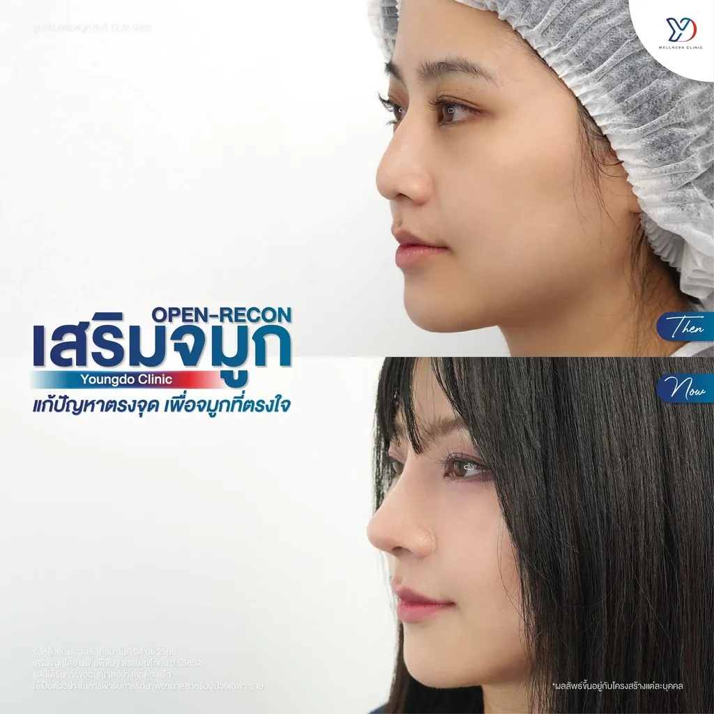 การเสริมจมูกแบบ Open Recon