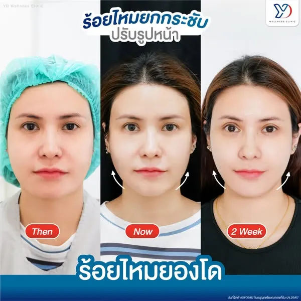 การร้อยไหมยกกระชับปรับรูปหน้า