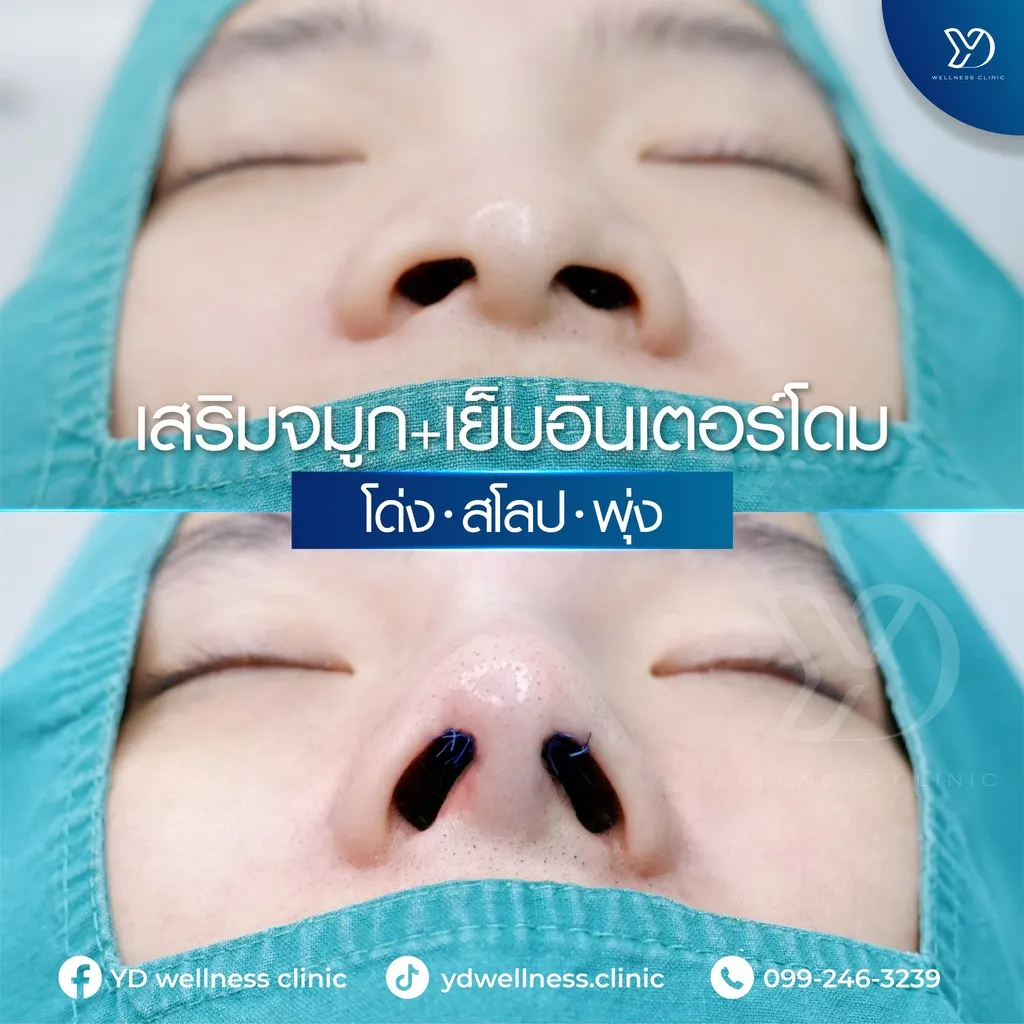 การเสริมจมูกร่วมกับการเย็บอินเตอร์โดม