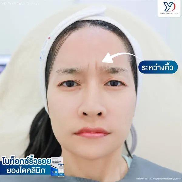 โบท็อกซ์ลดริ้วรอยระหว่างคิ้ว ก่อนทำ