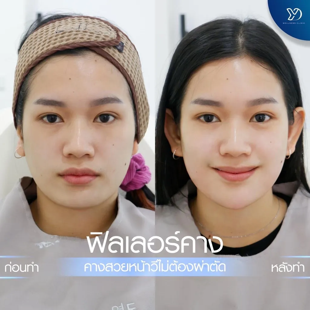 ฟิลเลอร์คาง ก่อน-หลัง