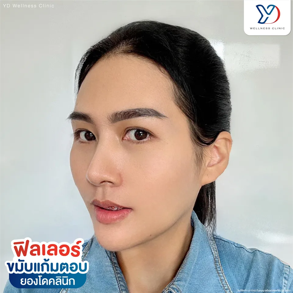 ฟิลเลอร์สำหรับขมับและแก้มตอบ