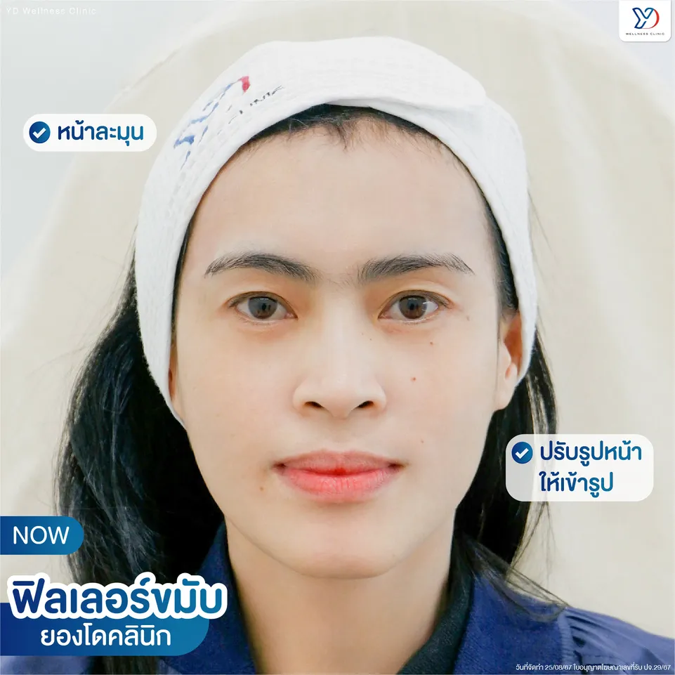 ฟิลเลอร์สำหรับขมับตอบ หลังทำ