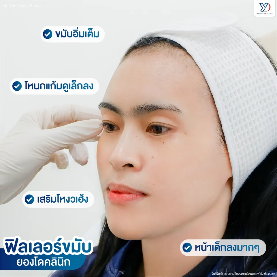 ฟิลเลอร์สำหรับขมับและแก้มตอบ