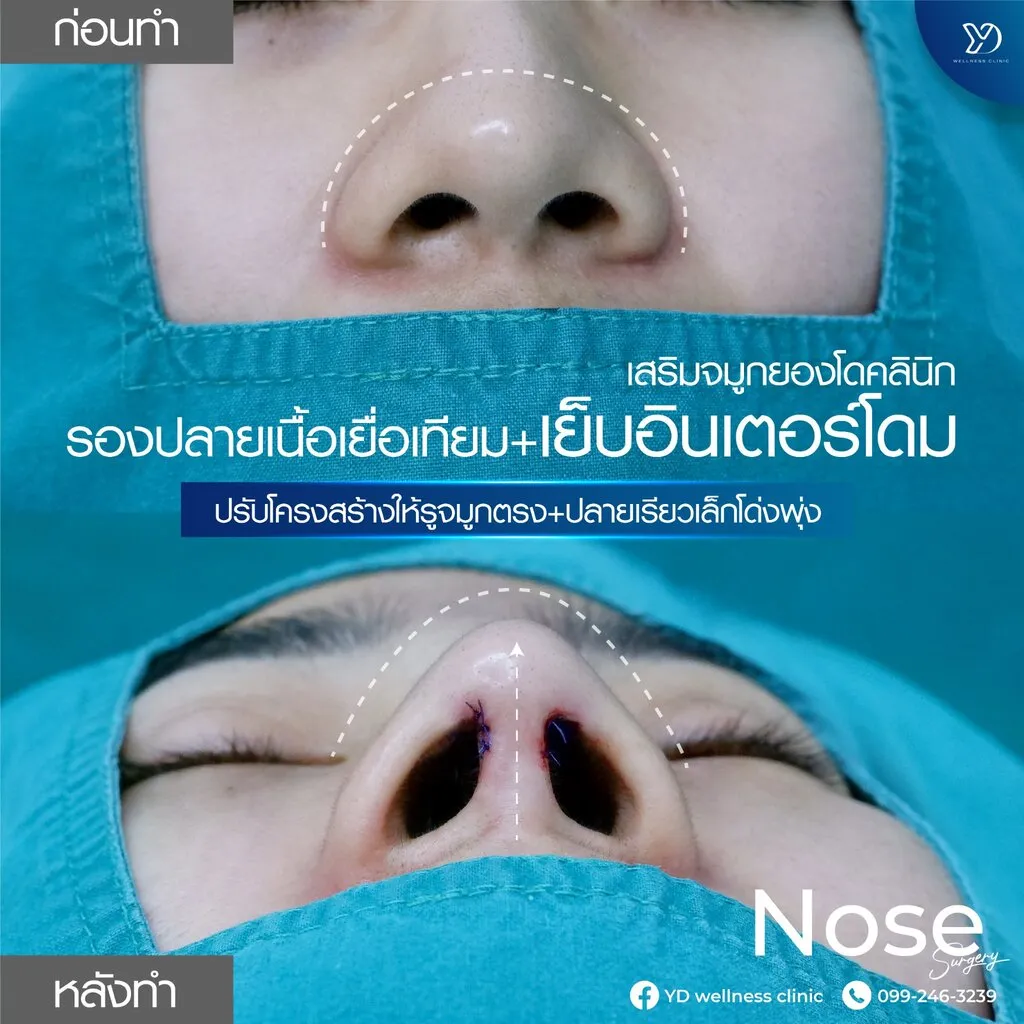 การเย็บอินเตอร์โดมที่จมูก ก่อน-หลัง