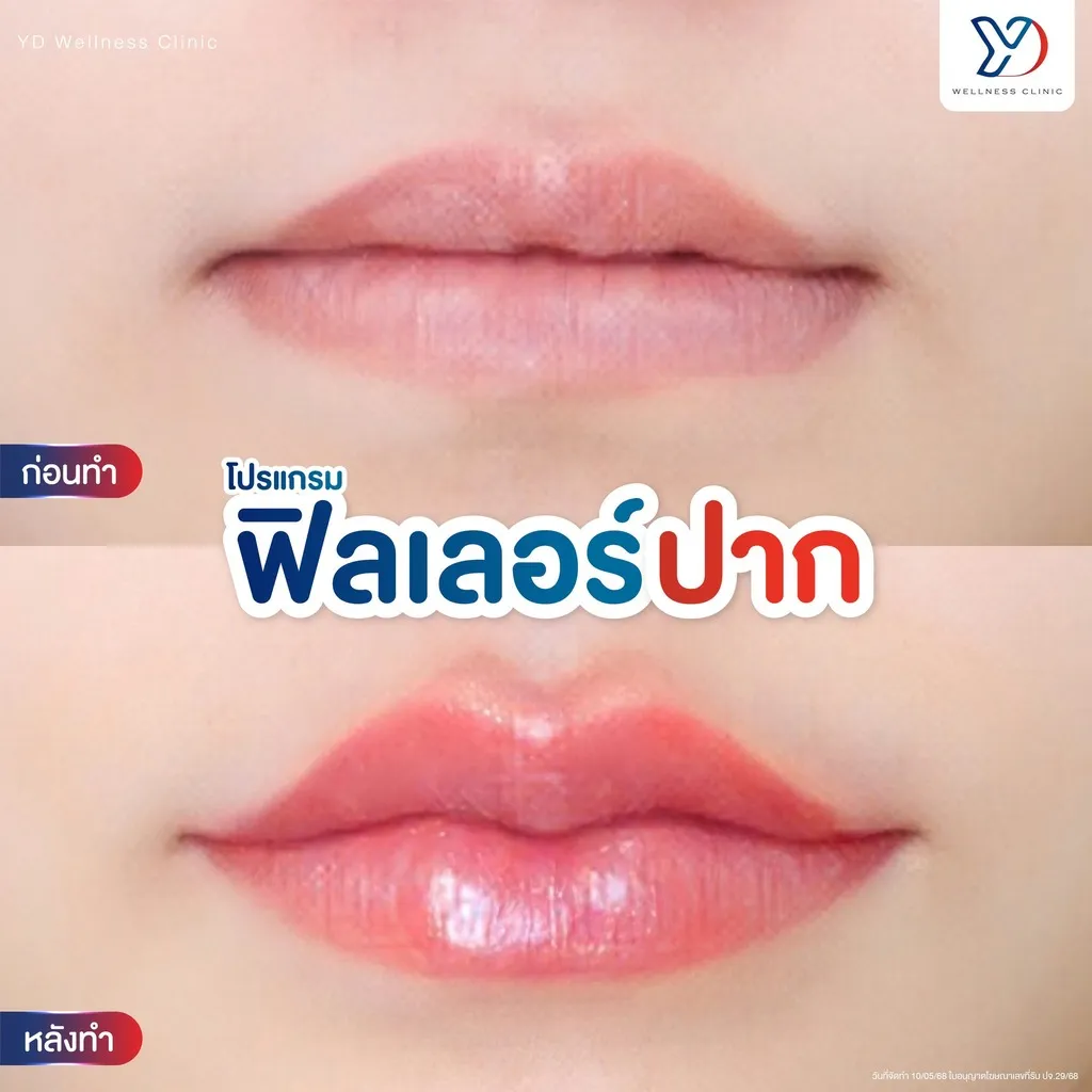 ฟิลเลอร์ปาก ก่อน-หลัง