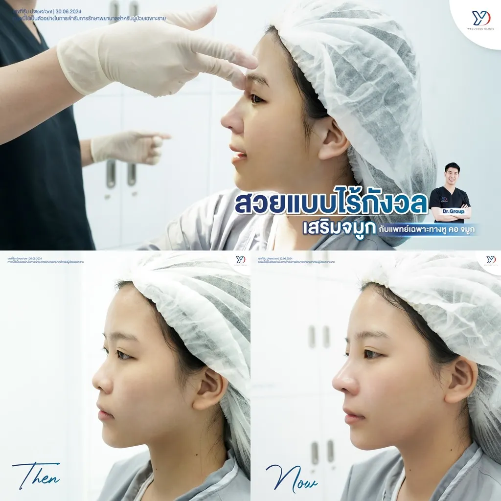 การเสริมจมูก ก่อน-หลัง