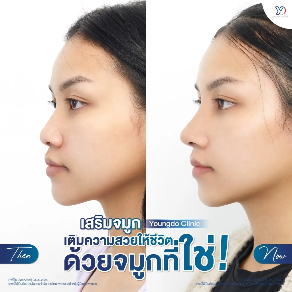 การเสริมจมูกที่ให้ลุคที่สมบูรณ์แบบ