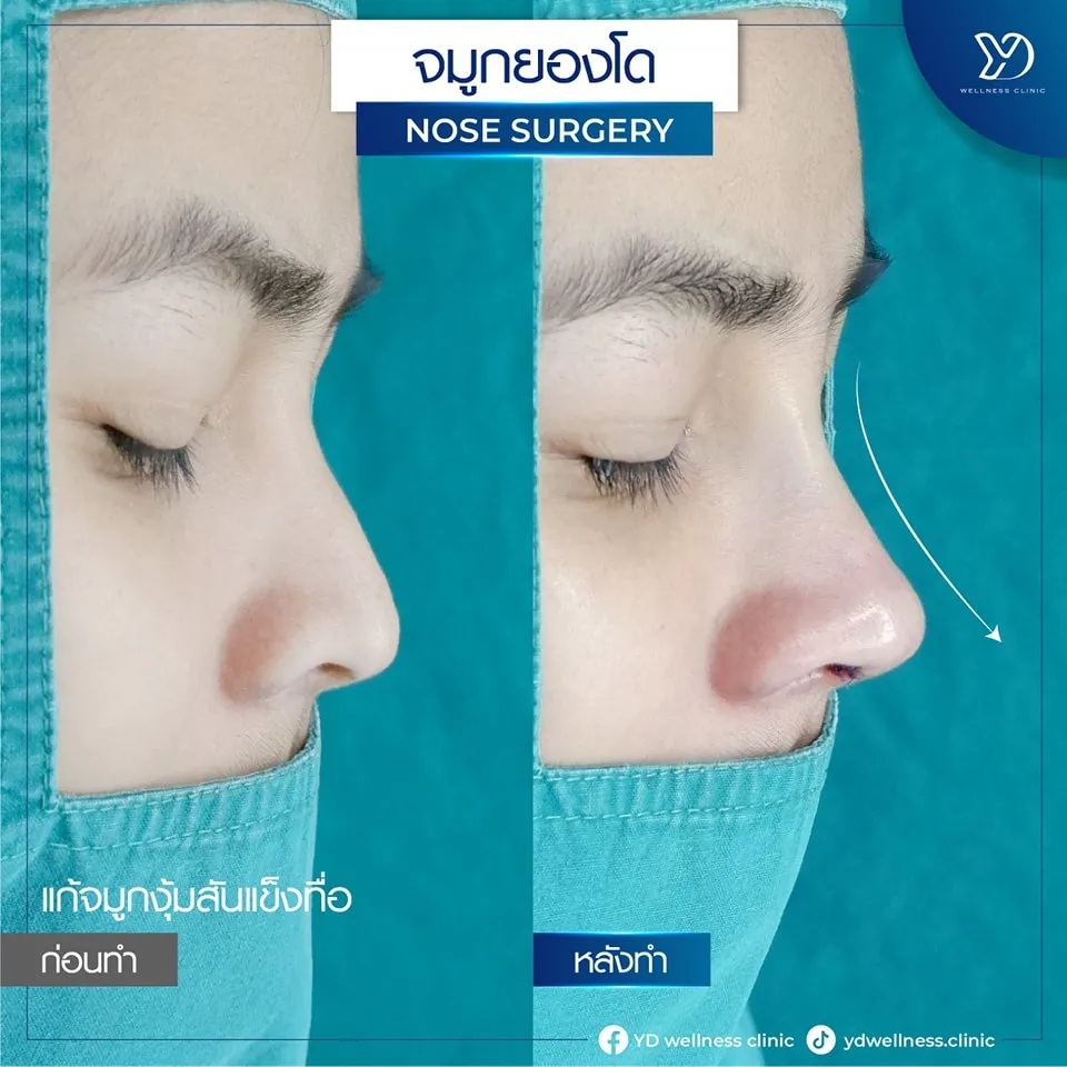 การแก้ไขจมูก ก่อน-หลัง