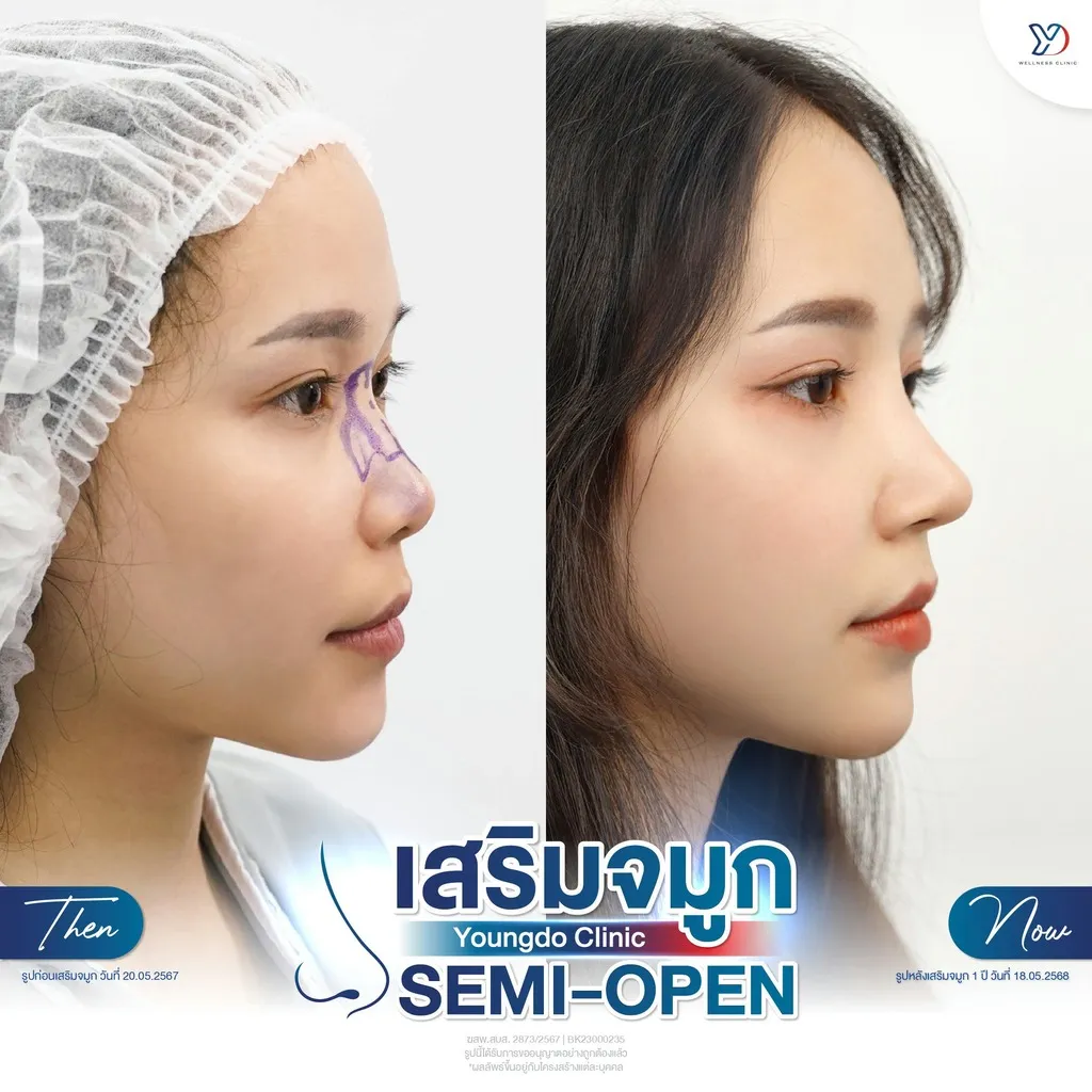 อัปเดตเสริมจมูก Semi-Open 1 ปี