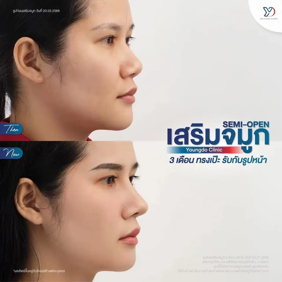 อัปเดตเสริมจมูก Semi-Open 3 เดือน