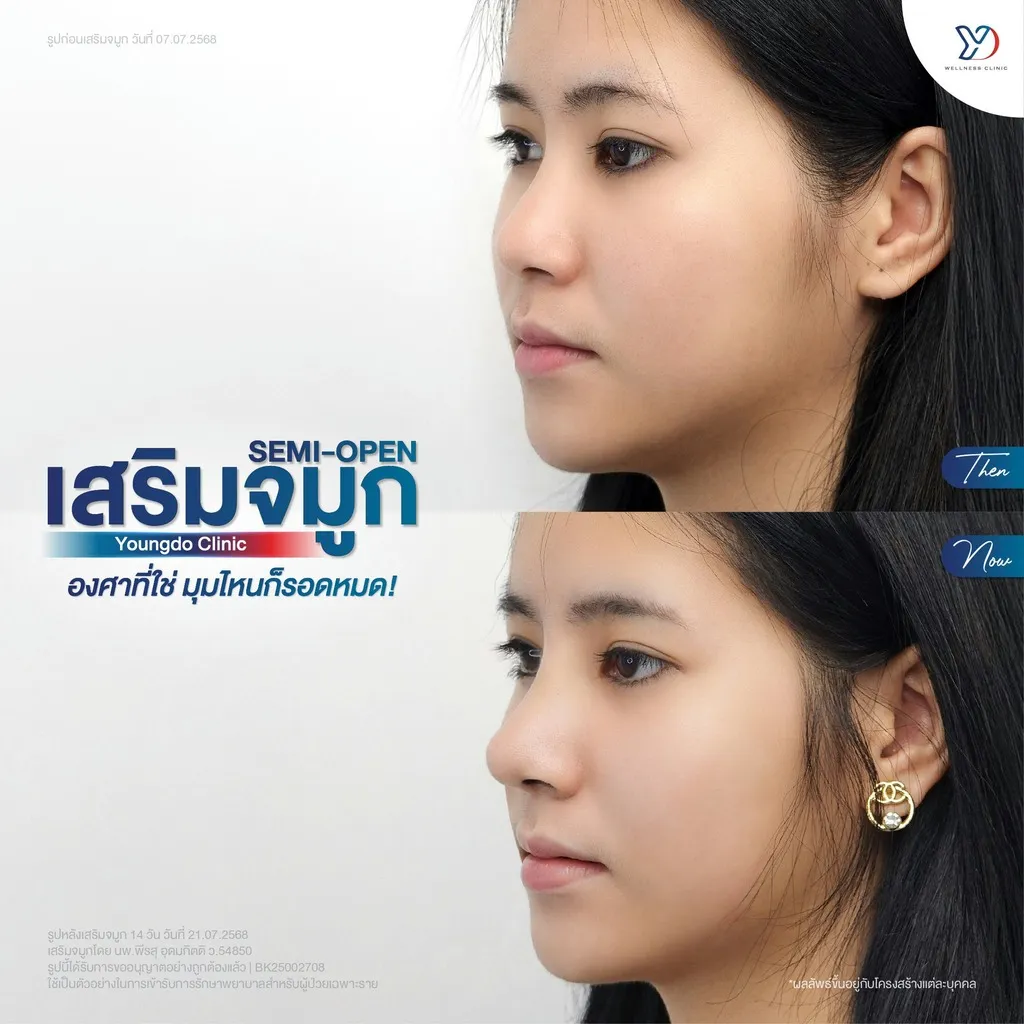 การเสริมจมูก Semi-Open มุมด้านข้าง