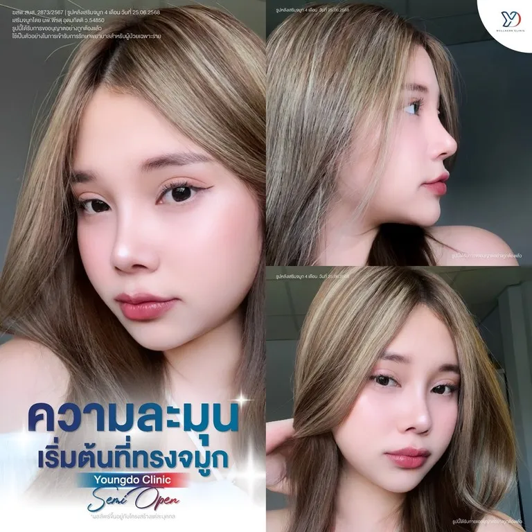ผลลัพธ์การเสริมจมูก Semi-Open