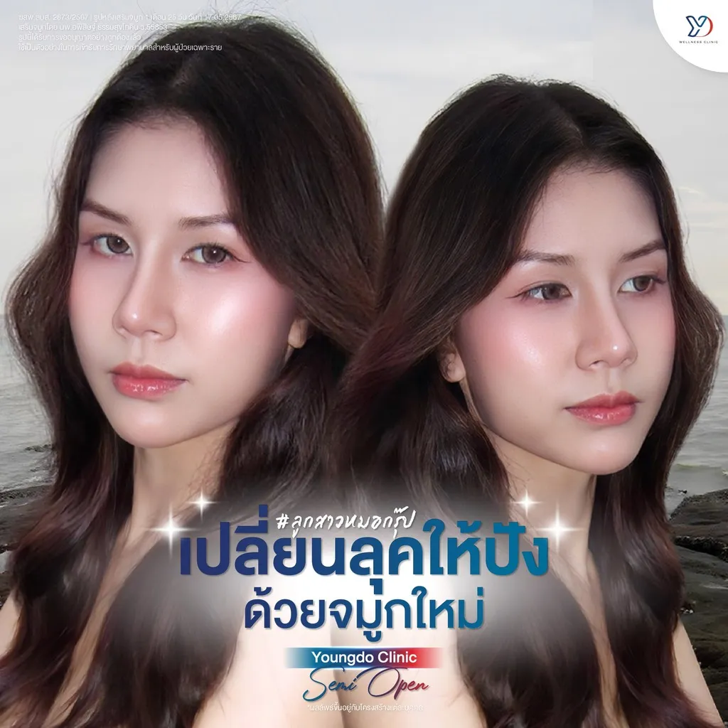 การแปลงโฉมด้วยการเสริมจมูก Semi-Open
