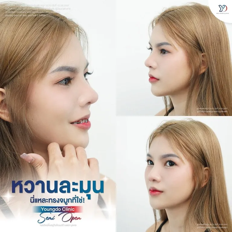 การเสริมจมูก Semi-Open ทรงหวานละมุน