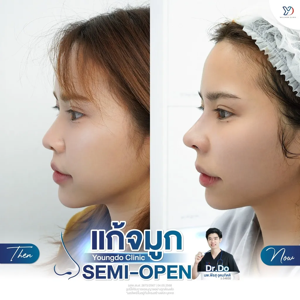 การแก้จมูกแบบ Semi-Open ก่อน-หลัง