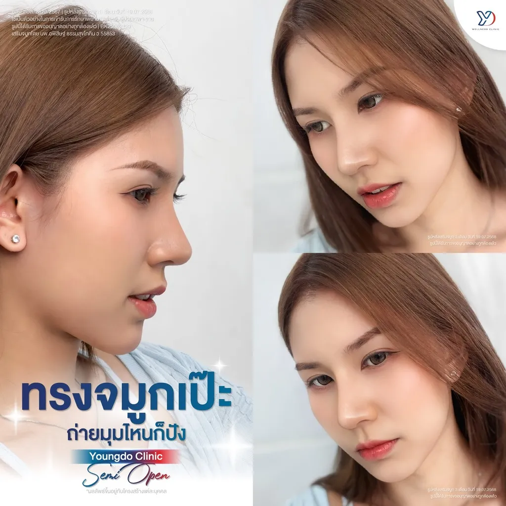 ทรงจมูกแบบ Semi-Open