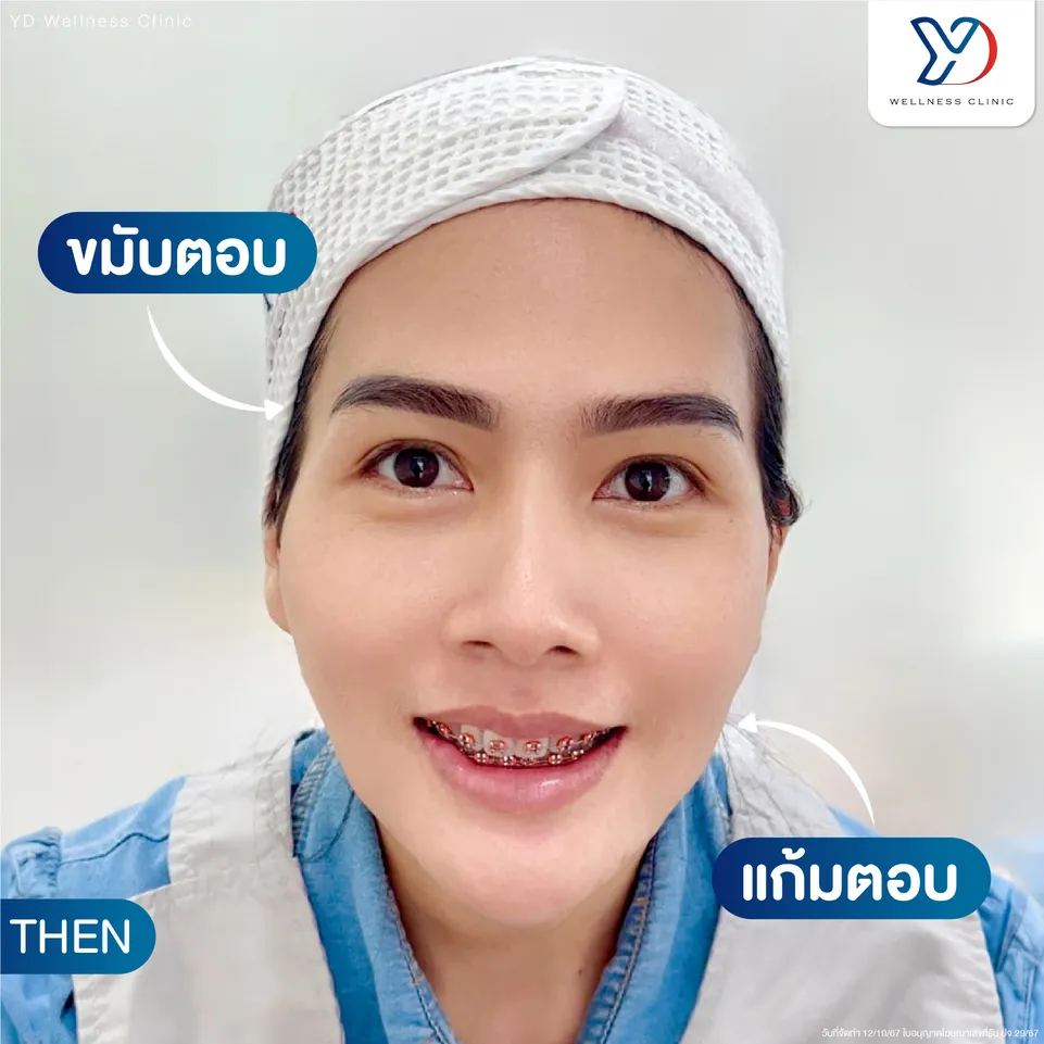 ขมับและแก้มตอบ ก่อนฉีดฟิลเลอร์
