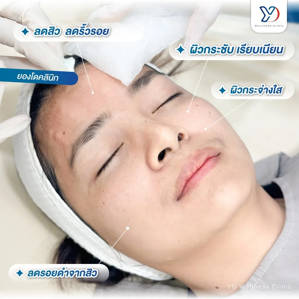 ประโยชน์ของการลดสิวและรอยสิว