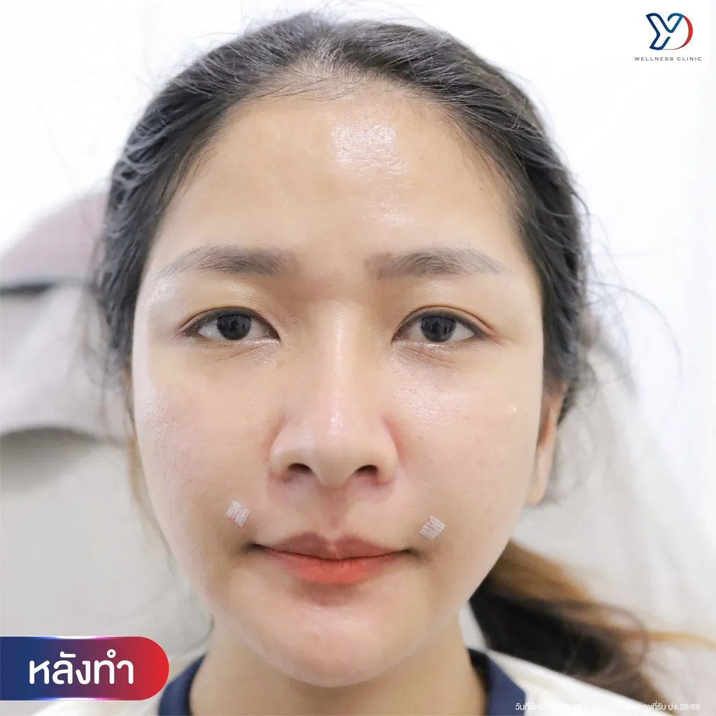 หลังฉีดฟิลเลอร์ร่องแก้ม มุมตรง