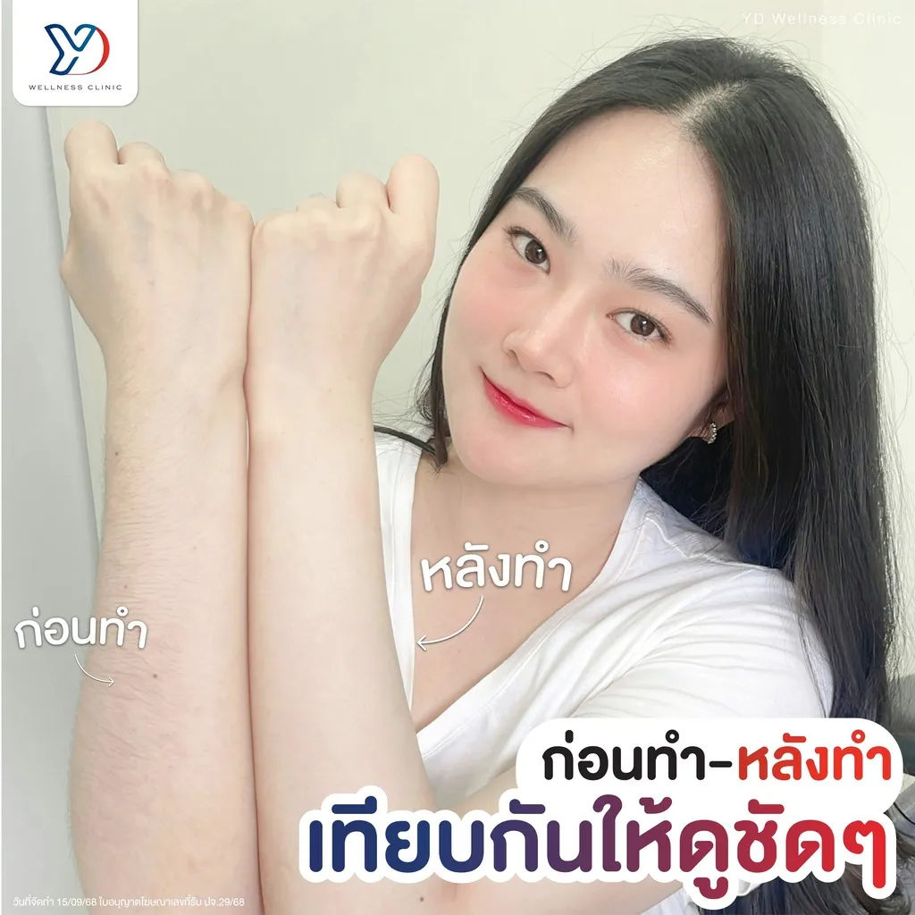 เปรียบเทียบการกำจัดขนแขน ก่อน-หลัง