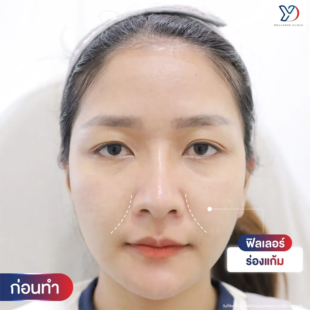 ก่อนฉีดฟิลเลอร์ร่องแก้ม มุมตรง