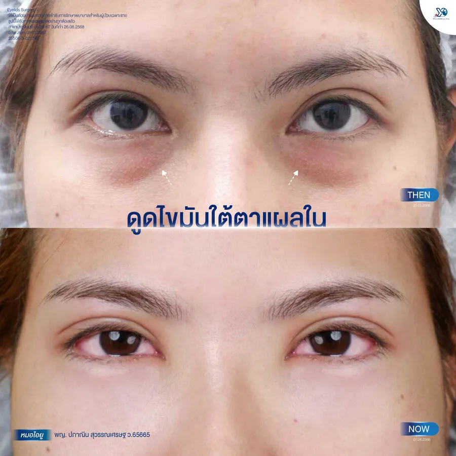 ดูดไขมันใต้ตาแผลใน ก่อน-หลัง (เฉพาะตา)