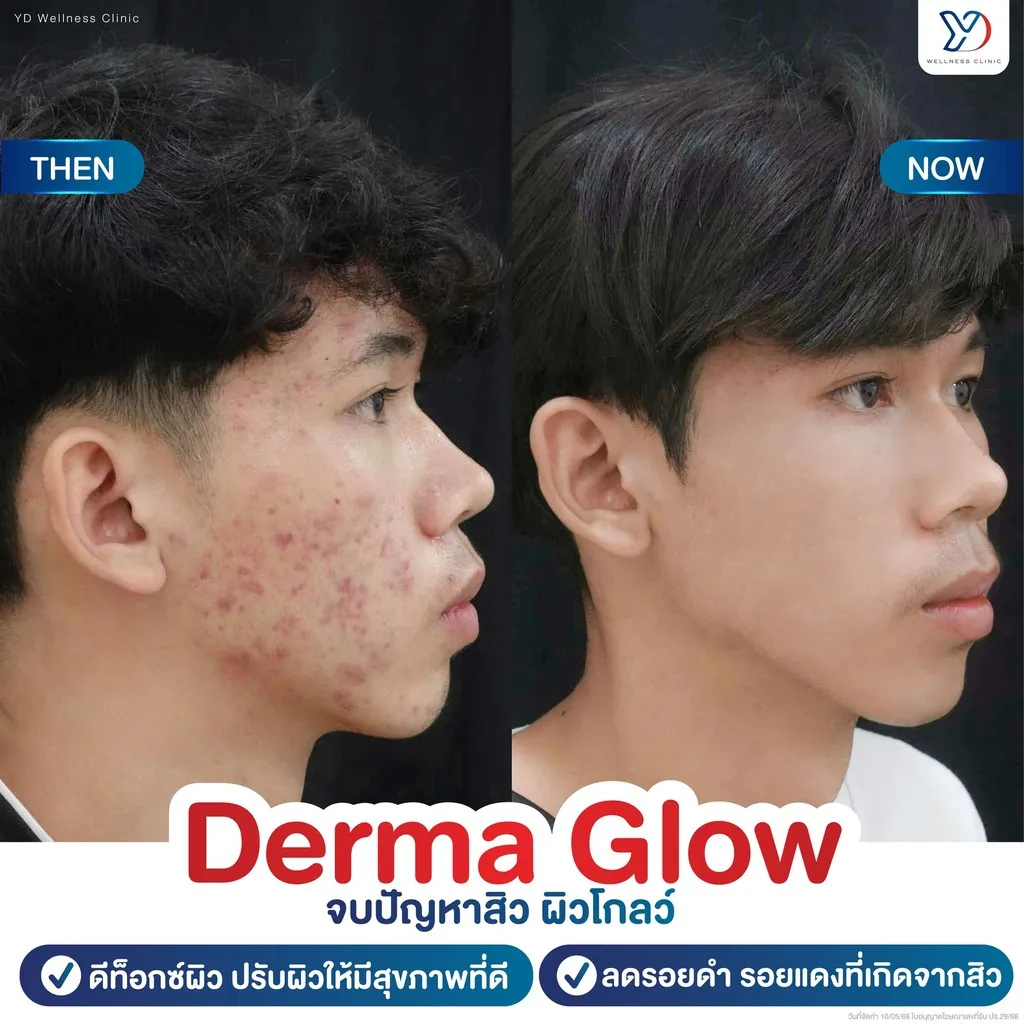 Derma Glow รักษาสิว ก่อน-หลัง