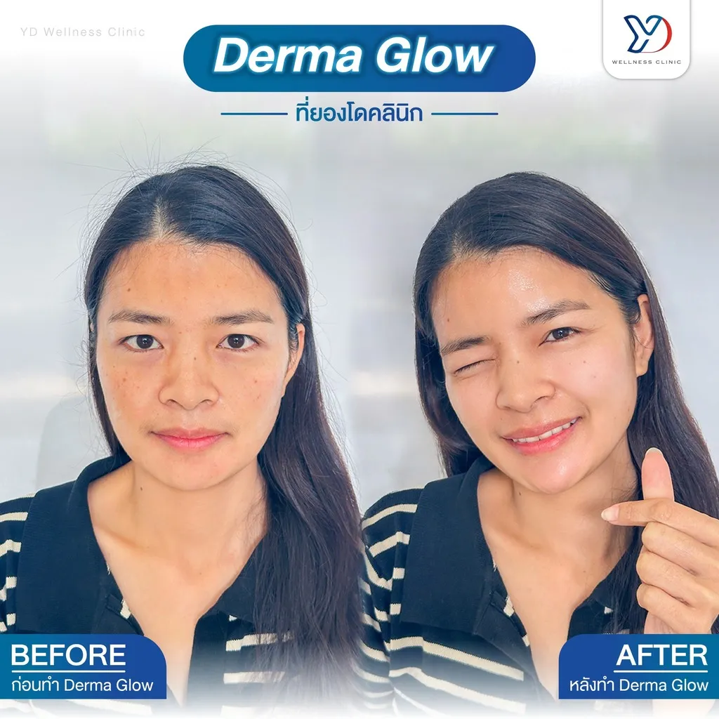 Derma Glow รอยสิวและฝ้า ก่อน-หลัง