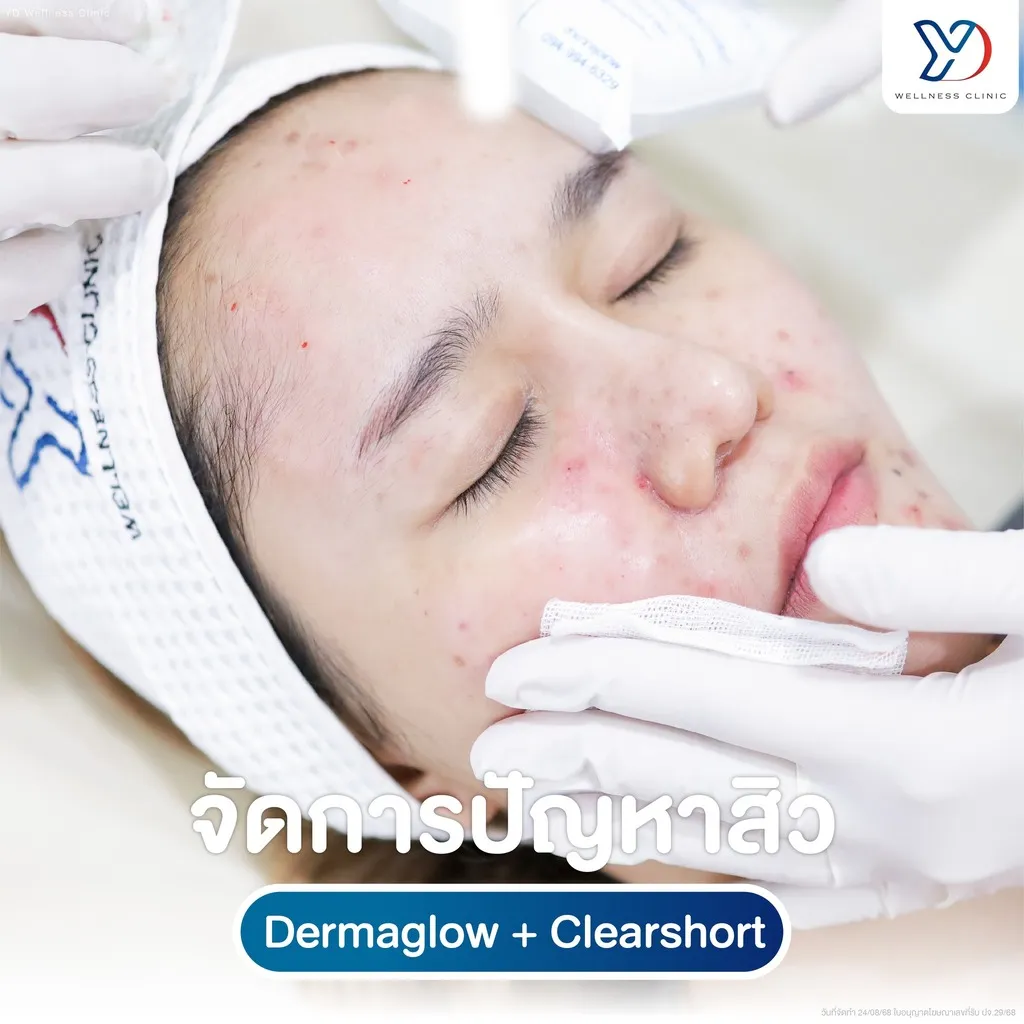 การจัดการปัญหาสิวด้วย Derma Glow และ Clearshort