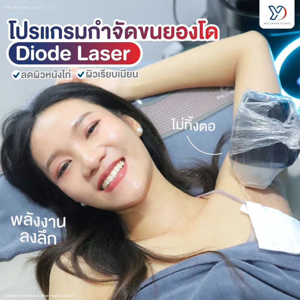 โปรแกรมกำจัดขนยองโด Diode Laser