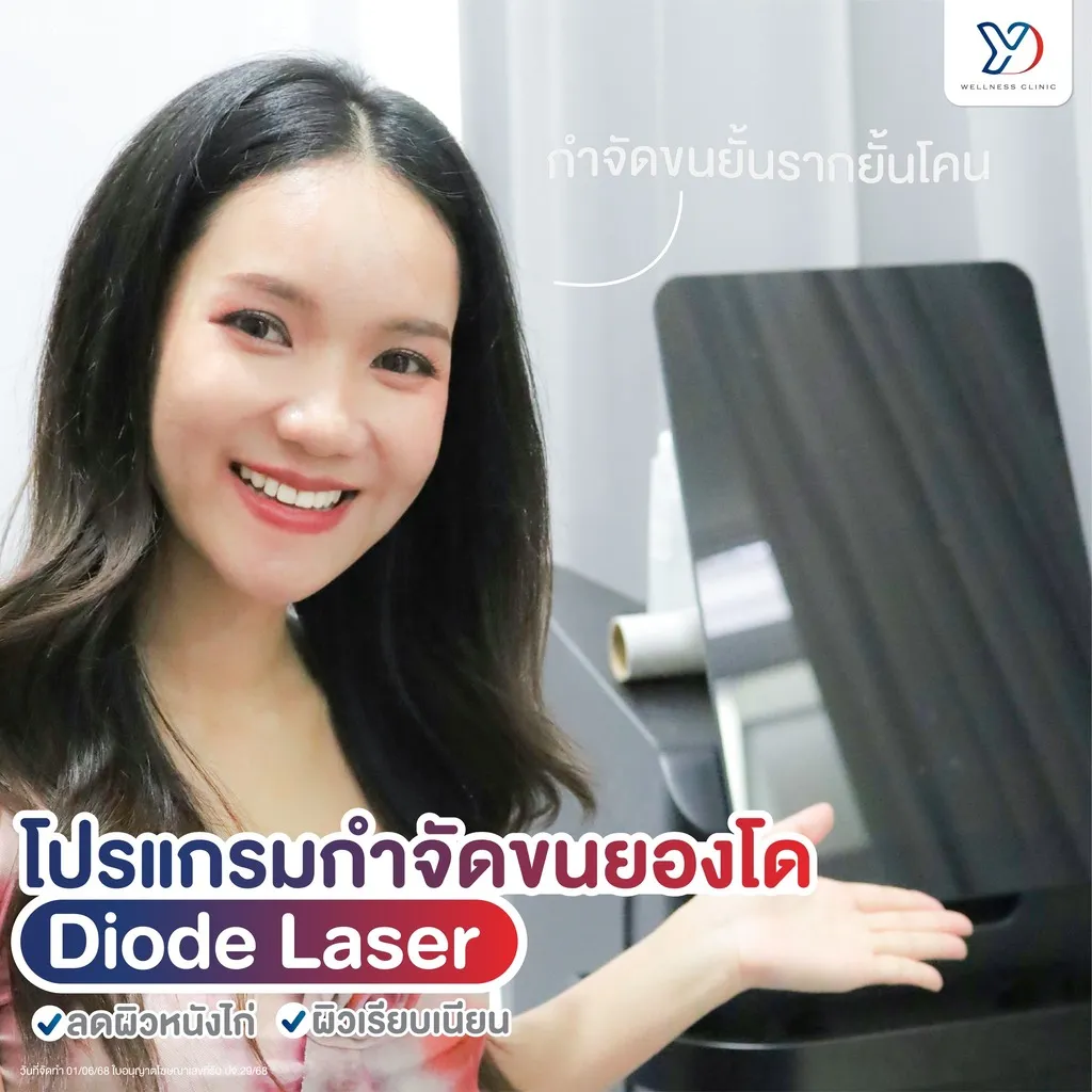 กำจัดขนด้วย Diode Laser ถึงรากถึงโคน