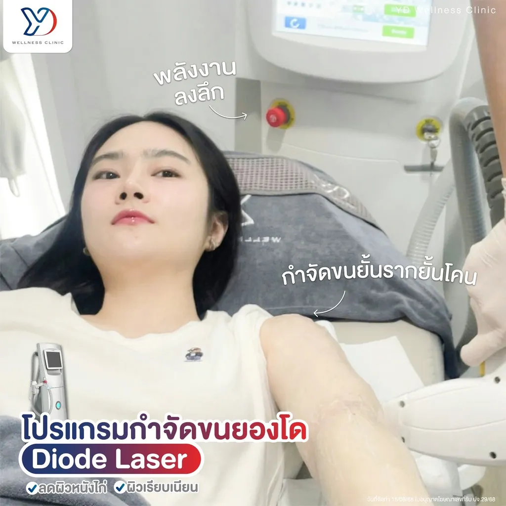 การใช้ Diode Laser กำจัดขนแขน