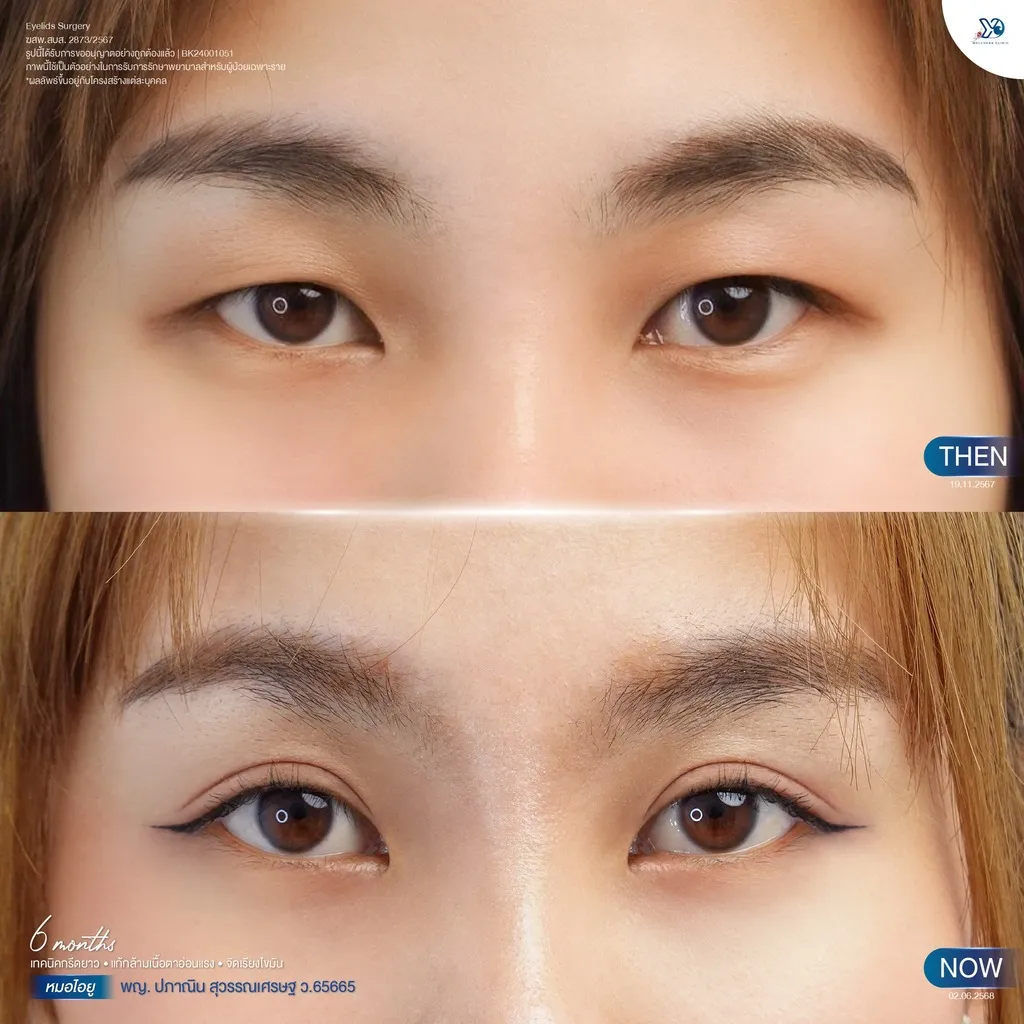 ศัลยกรรมตาสองชั้น ก่อน-หลัง 6 เดือน