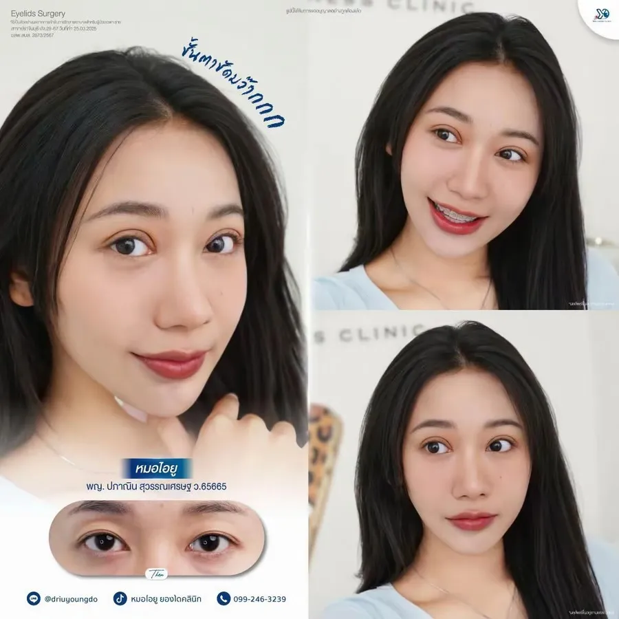 ศัลยกรรมตาสองชั้น ก่อน-หลัง (ภาพบุคคล)