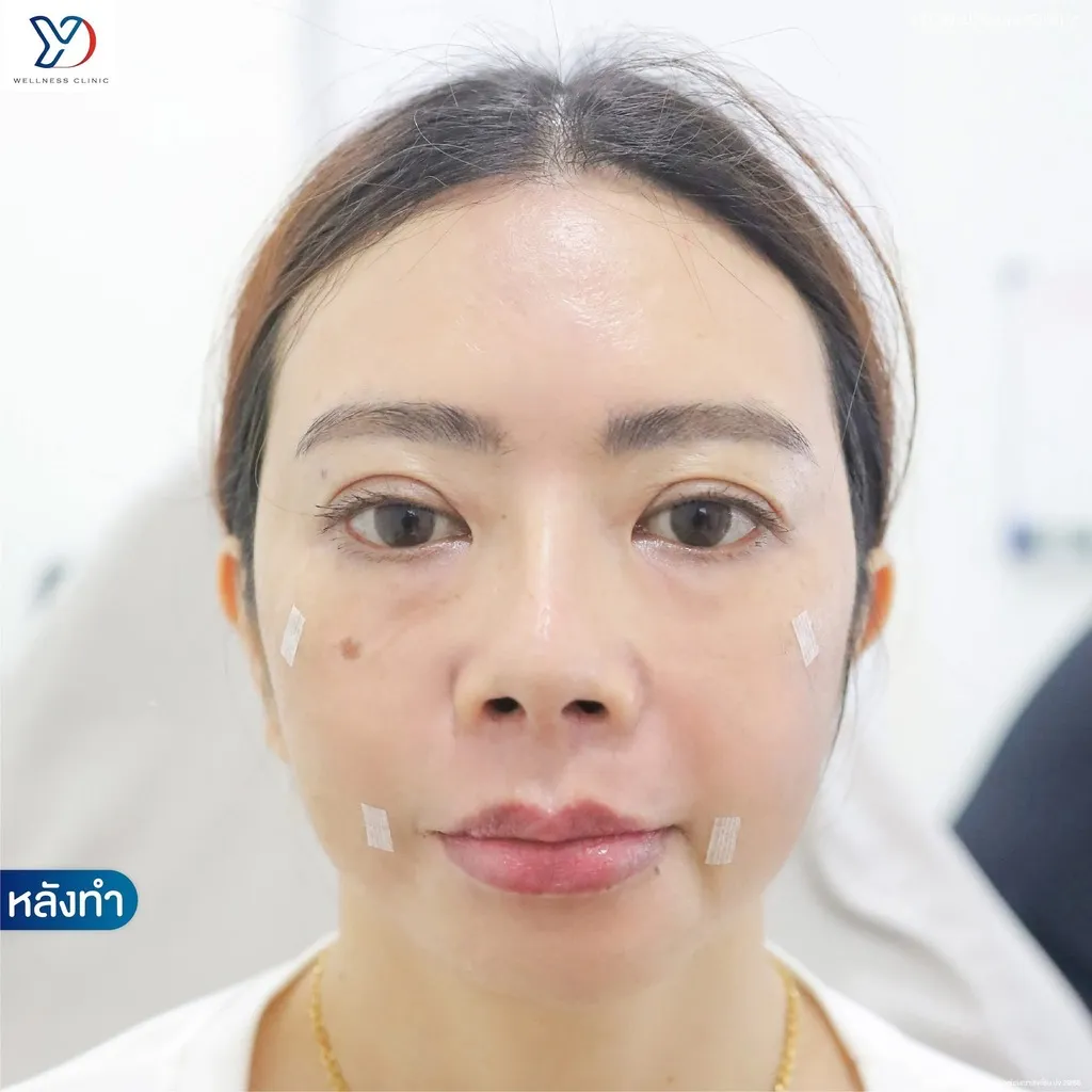 หลังฉีดฟิลเลอร์แก้ไขหน้าตอบ