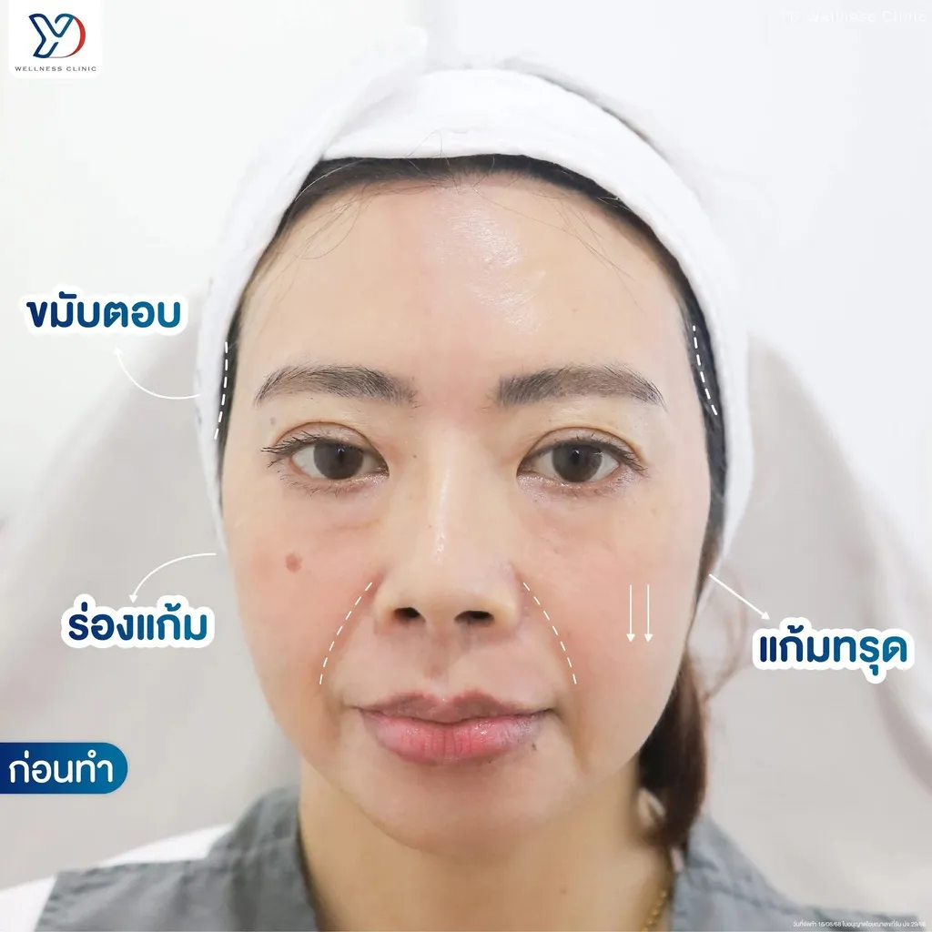 ปัญหาหน้าตอบก่อนฉีดฟิลเลอร์