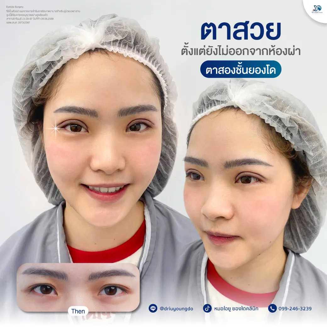 ตาสวยทันทีหลังผ่าตัด