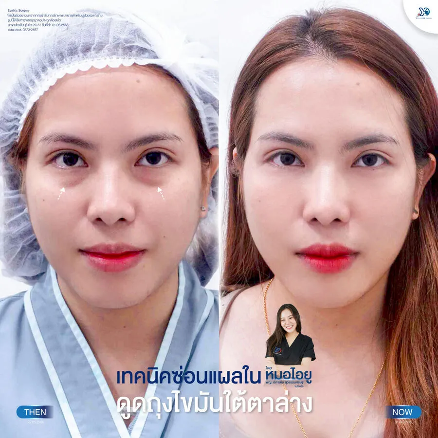 การดูดไขมันใต้ตาแผลใน ก่อน-หลัง
